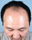 Before Hair Transplant&nbsp;Front