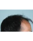 Before Hair Transplant&nbsp;2 Sessions (Areas)