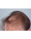 Before Hair Transplant&nbsp;Revision