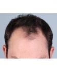 Before Hair Transplant&nbsp;Front