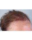 Before Hair Transplant&nbsp;Revision