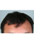 Before Hair Transplant &nbsp;Front