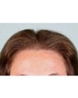Before Hair Transplant&nbsp;Hair Thinning