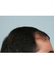 Before Hair Transplant&nbsp;Front