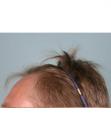 Before Hair Transplant&nbsp;Hairlines