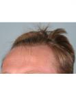 Before Hair Transplant&nbsp;Hairlines