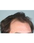 Before Hair Transplant&nbsp;Hairlines