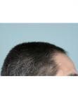 Before Hair Transplant&nbsp;Front