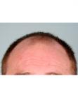 Before Hair Transplant &nbsp;Front