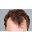Before Hair Transplant&nbsp;Hairlines