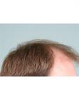 Before Hair Transplant&nbsp;Front