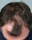 Before Hair Transplant&nbsp;Front