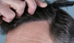 Before Hair Transplant&nbsp;Front