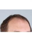 Before Hair Transplant&nbsp;Front