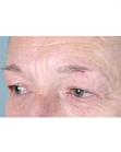 Before Hair Transplant&nbsp;Eyebrows