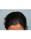 Before Hair Transplant&nbsp;Hair Thinning