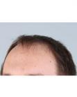 Before Hair Transplant&nbsp;Front