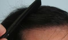 Before Hair Transplant&nbsp;2 Sessions (Areas)
