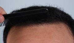 Before Hair Transplant&nbsp;2 Sessions (Areas)