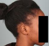 Hair Transplant&nbsp;Traction Alopecia
