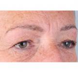 Hair Transplant&nbsp;Eyebrows